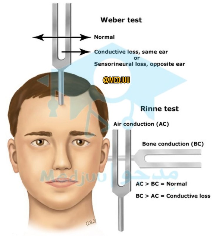 *****?***نحوه و تشخیص تست های weber …