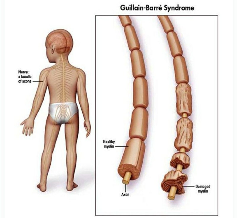 **Синдром Гийена — Барре (СГБ)** — …