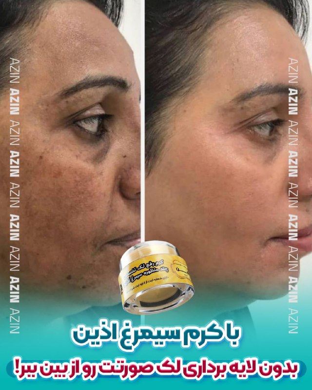 ***?***اکثر کرمهای رفع لک ،لایه بردار …