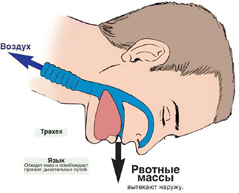 **Обеспечение проходимости дыхательных путей**.