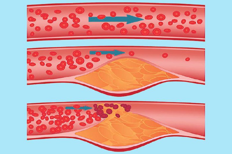 ***❓*****Всегда ли небольшие холестериновые бляшки безобидны?**
