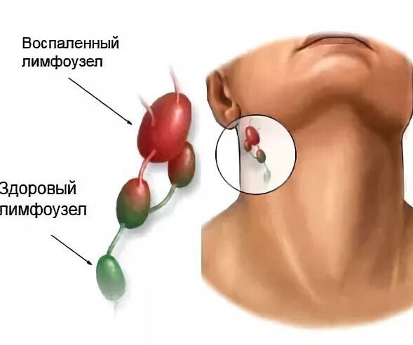 [​](https://telegra.ph/file/ce5ee31b20480a350fa5c.jpg)КАКИЕ ТРАВЫ ПОМОГУТ ПРИ ВОСПАЛЕННЫХ ЛИМФАТИЧЕСКИХ …