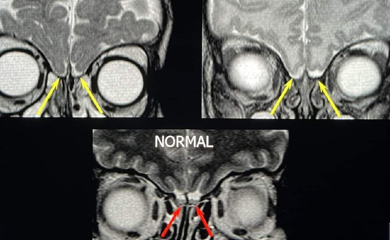 Failure of normal cleavage of [#telencephalon](?q=%23telencephalon) …