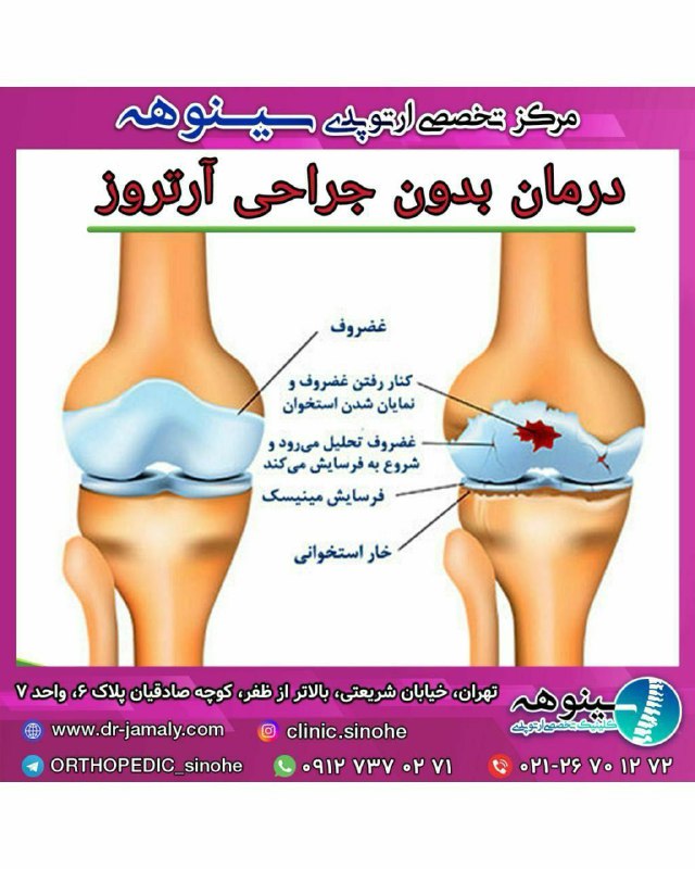 خبری خوش برای بیماران دیسک کمر …