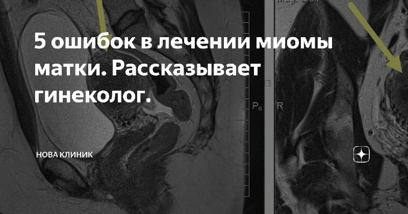 ***📎***[Написали](https://dzen.ru/media/id/5e8579c460f2aa358126212c/5-oshibok-v-lechenii-miomy-matki-rasskazyvaet-ginekolog-6746ce4395ad9074c0c087d6) о **5 самых частных ошибках** …