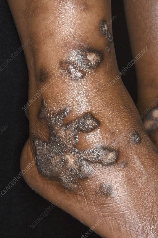 Hypertrophic lichen planus