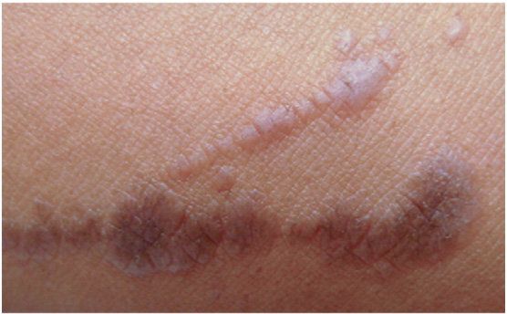 Linear lichen planus