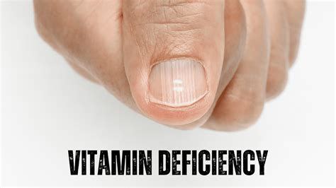 "Vitamin deficiency is mainly present for …