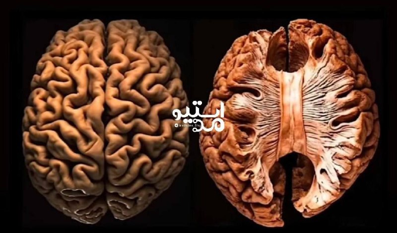 ***❗️***کمبود خواب میتواند باعث شود مغز …