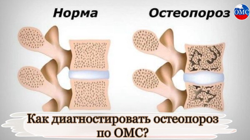 ***👨‍⚕️*****Как диагностировать остеопороз по ОМС?**