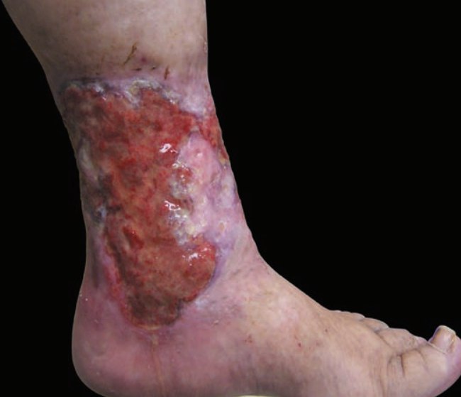 ***🔺***Venous stasis ulcer in the typical …