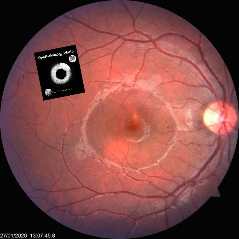 Central serous retinopathy