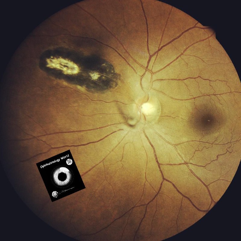 Retinal scar