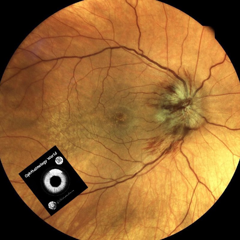 Disc edema and hemorrhaging Suspected (non-arteritic …