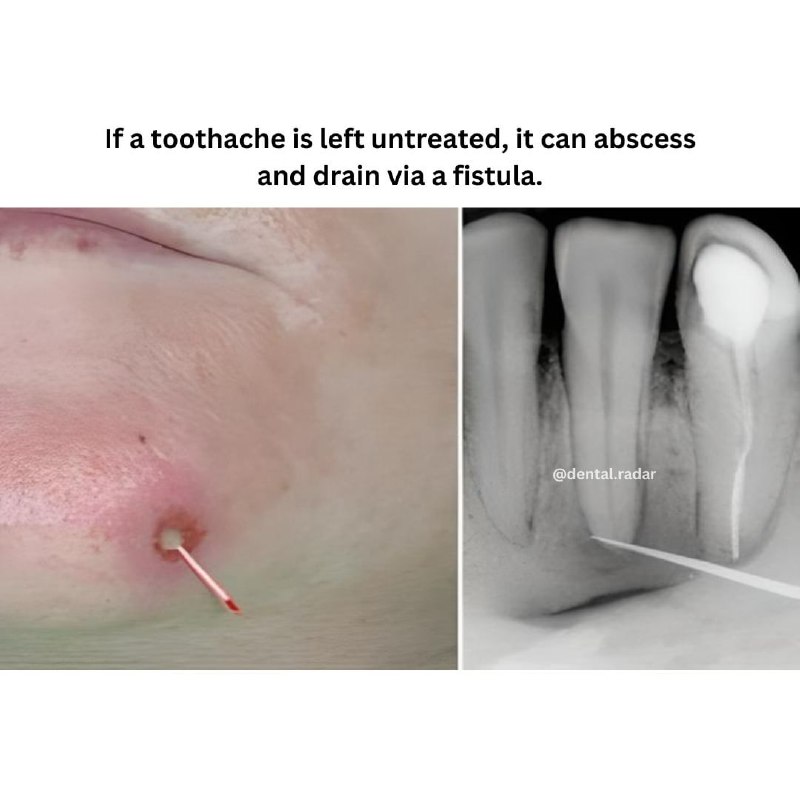 *****🟡***** **الخراج - abscess**