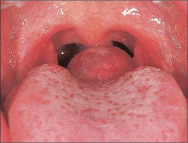 ***?***thyroid ectopic