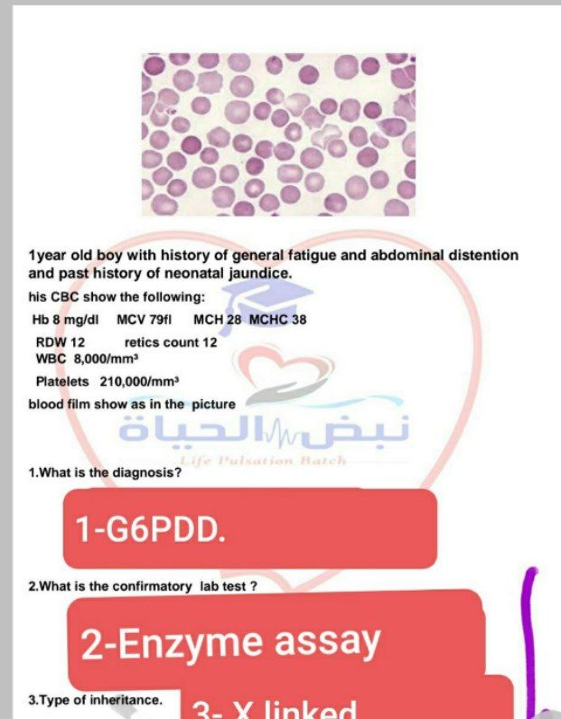 ***⭕️***Spherocytosis due to (hx of abdominal …