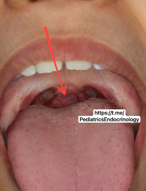 Ectopic Thyroid (sublingual type)