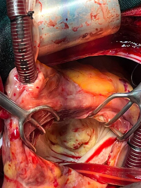 Critical mitral stenosis ...***😱***