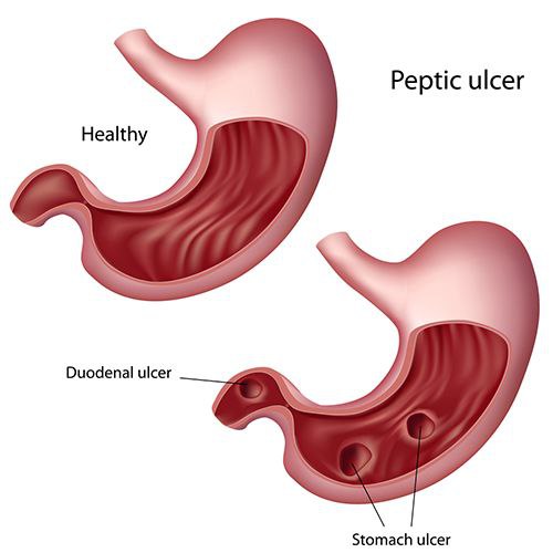 ***🔆***شنو الفرق بين قرحة المعدةgastric ulcer …