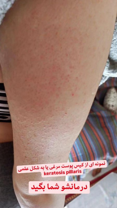 درمان پوست مرغی(keratosis pillaris) رو ببینید
