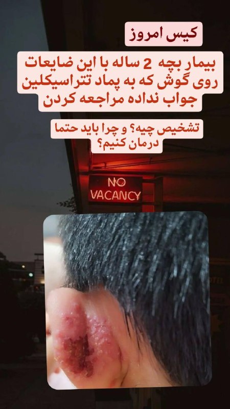 بررسی کیس هرپس گوش و لزوم …