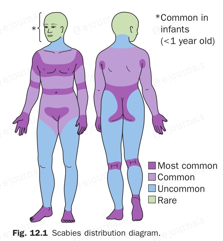 ***🔵***الجرب Scabies : ***▪***︎وهو غزو طفيلي …