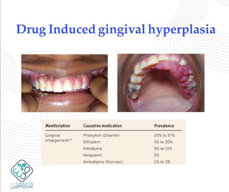 [#Drug\_Induced\_gingival\_hyperplasia](?q=%23Drug_Induced_gingival_hyperplasia)