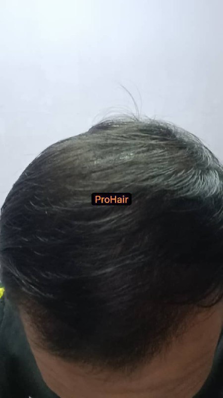 ProHair - Solusi Rambut Gugur