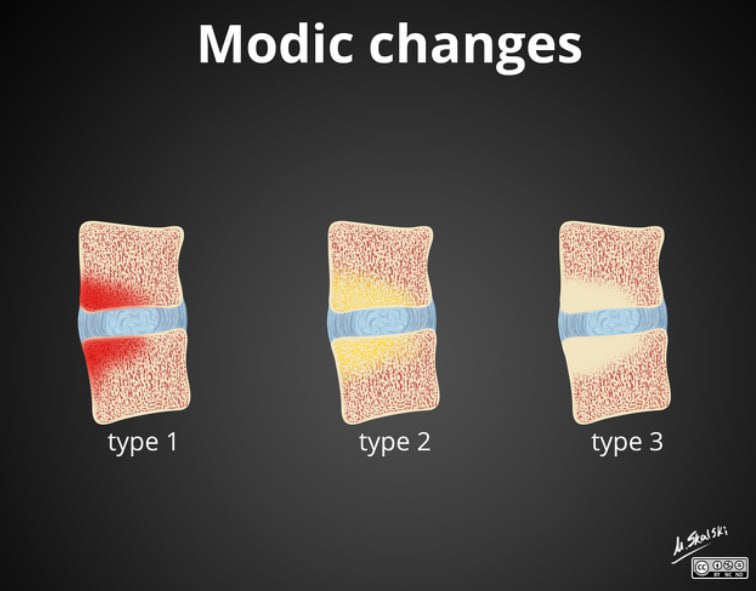 **Типи** **Modic changes**