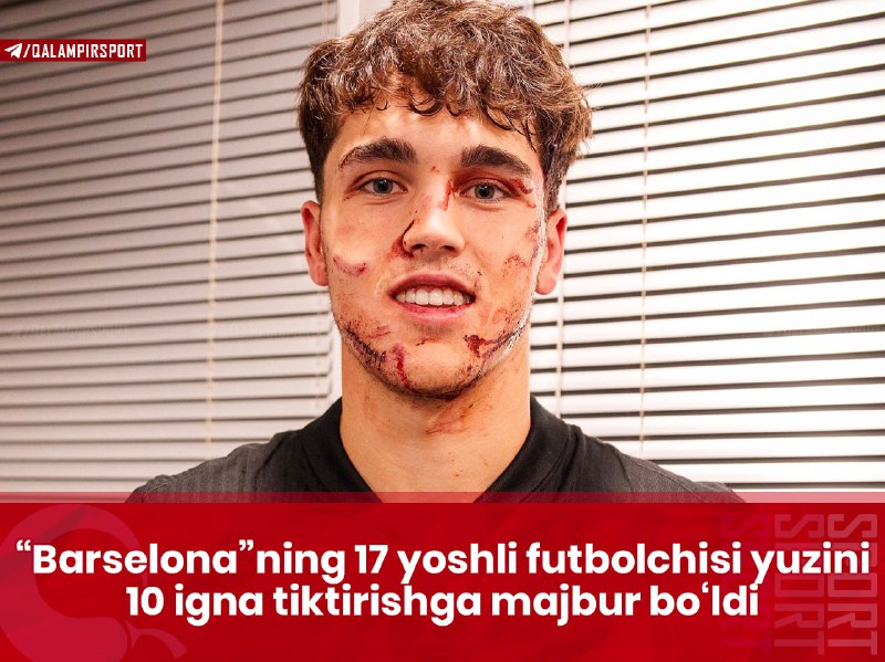 **“Barselona”ning 17 yoshli futbolchisi yuzini 10 …