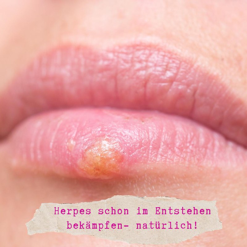 **Wer Herpes hat, weiß, wie schmerzhaft …