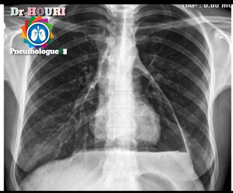 ***🔴***[#PNEUMOPÉRICARDE](?q=%23PNEUMOP%C3%89RICARDE).