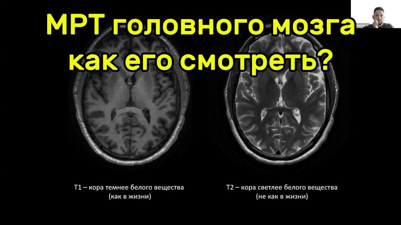 Вот и наш второй вебинар про то, как смотреть МРТ головного мозга. Как и обещал, выкладываю запись вебинара. Спасибо всем, …