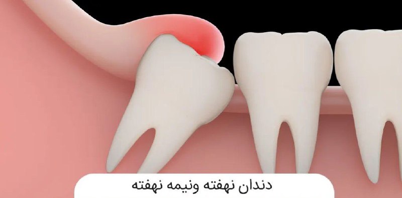 ***⭕️*** دندان نهفته چه خطراتی دارد؟