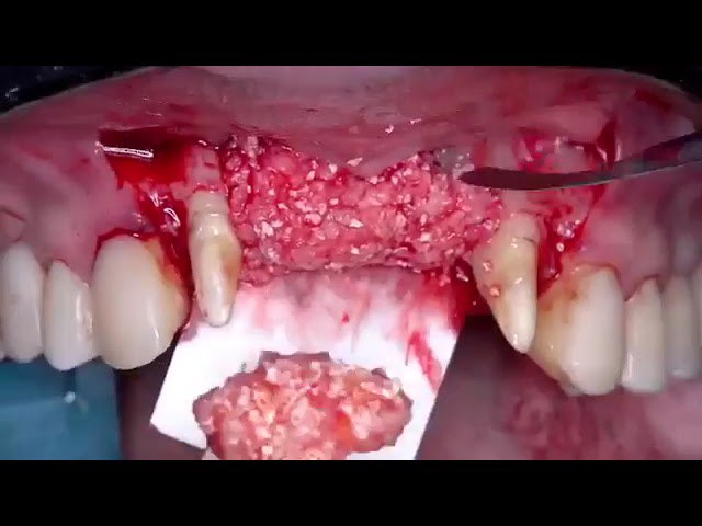 bone graft in anterior teeth