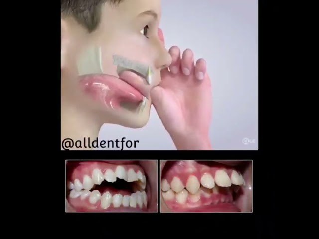 اضرار مص الأصبع لدى الأطفال..