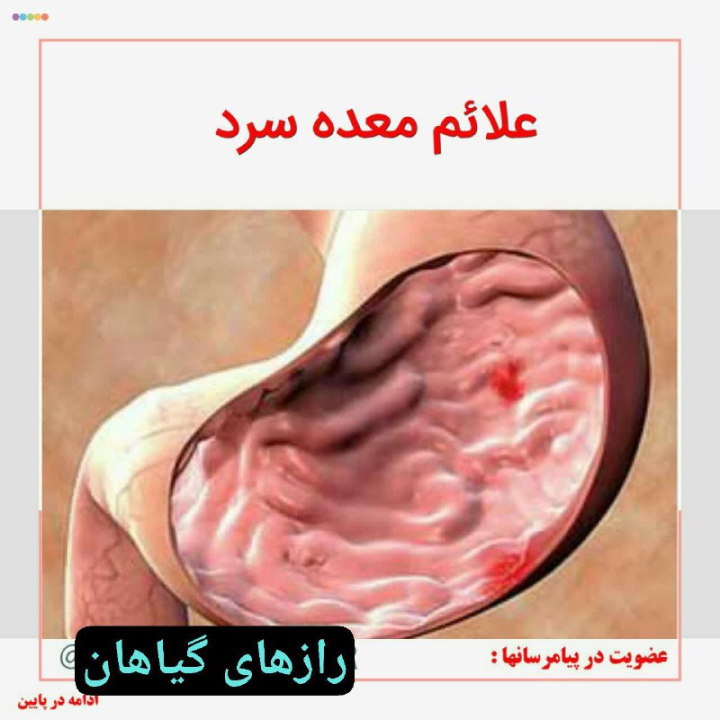 علائم [#معده\_سرد](?q=%23%D9%85%D8%B9%D8%AF%D9%87_%D8%B3%D8%B1%D8%AF)