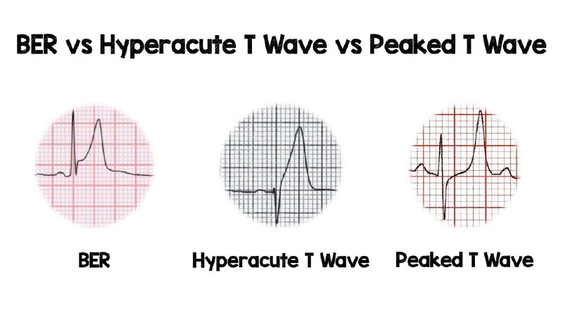 ***⭐️***BER vs Hyperacute T Waves vs …