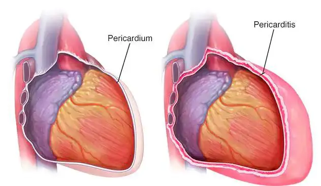 **Pericarditis (هەوکردنی پەڕدەی دڵ)**