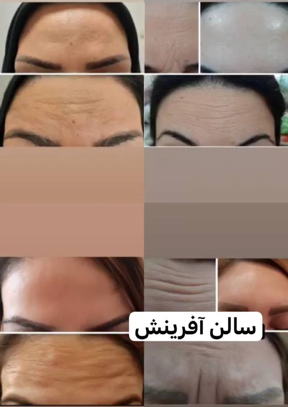 بوتاکس صورت***✅***