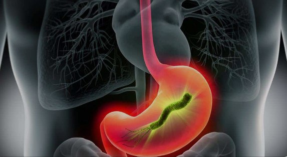 **¿Problemas estomacales? Quizá es ‘Helicobacter pylori’**