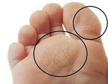 ***?******?*** افراددیابتی به علت عوارض نوروپاتی …
