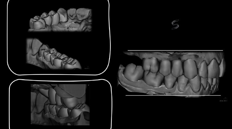 SemDent: EXOCAD