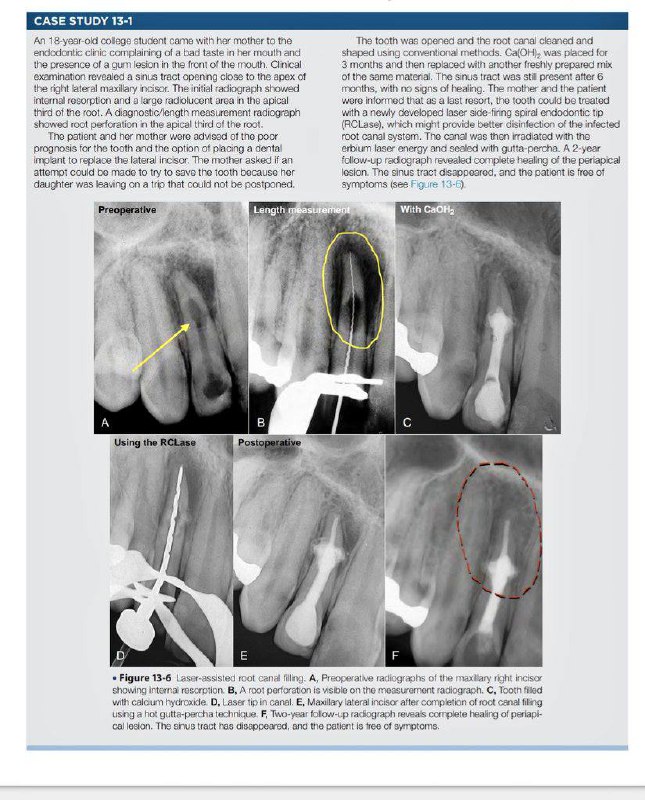 [Laser in endodontics](https://t.me/super_dentists)