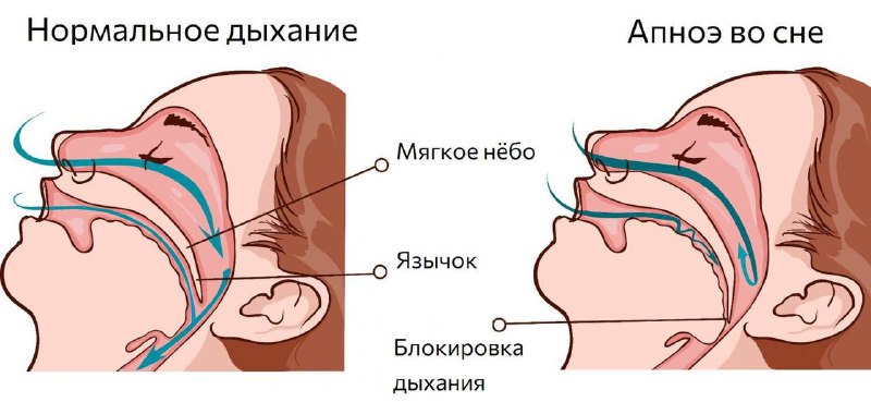 **Хуррак отишга қарши уй шароитида курашинг**