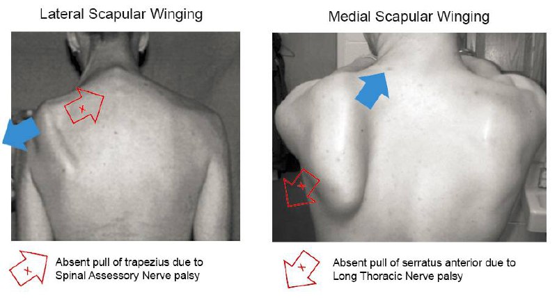 ***✅*** ال winging of scapula