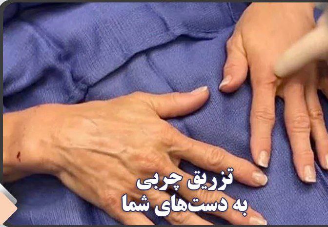 ***▪️***تزریق چربی به دست؛