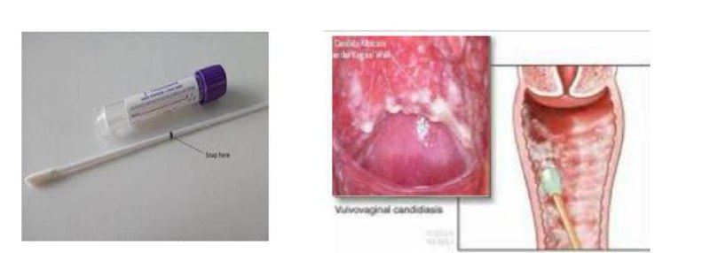 **vaginal swab** **of valvovaginal candidiasis**