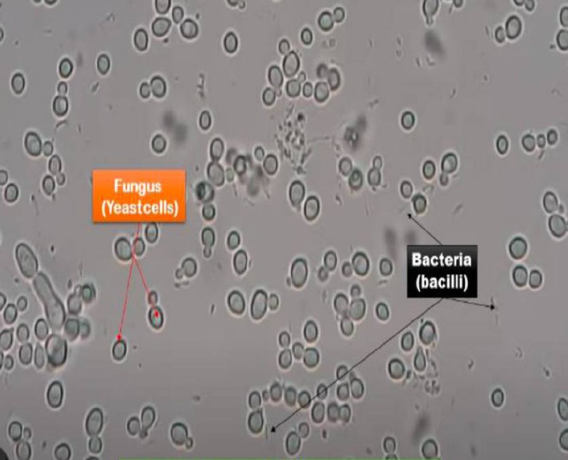 **Wet mount microscopy of Candida**